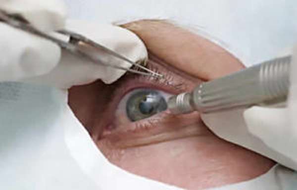 хирургическая операция на глаза